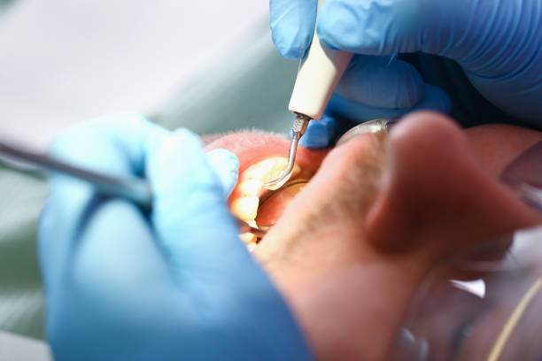 Best Urgent Care for Lost Fillings or Crowns in Pierre, SD
