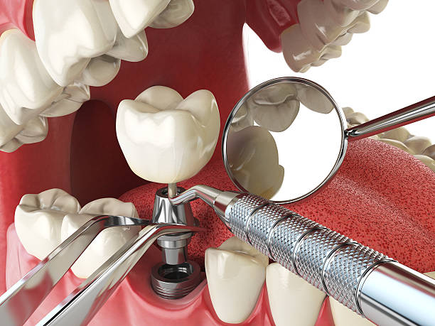 Best Emergency Gum Treatment in Pierre, SD